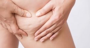 Santé et beauté : La cellulite, qu’est-ce que c’est?