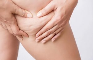 Santé et beauté : La cellulite, qu’est-ce que c’est?